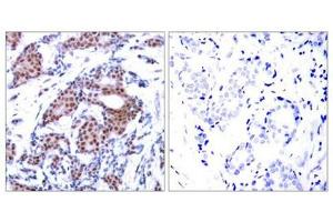 Immunohistochemical analysis of paraffin-embedded human breast carcinoma tissue using Elk-1(Phospho-Ser383) Antibody(left) or the same antibody preincubated with blocking peptide(right). (ELK1 抗体  (pSer383))
