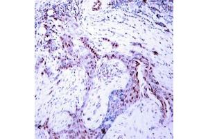 Immunohistochemical analysis of paraffin-embedded human breast carcinoma tissue using Progesterone Receptor(Phospho-Ser190) Antibody. (Progesterone Receptor 抗体  (pSer190))