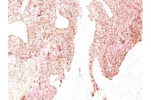 Formalin-fixed, paraffin-embedded human Small Cell Lung Carcinoma stained with Chromogranin A Monoclonal Antibody (LK2H10) (Chromogranin A 抗体)
