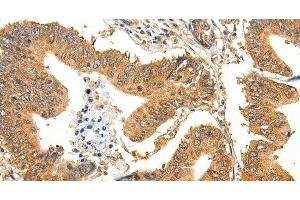 Immunohistochemistry of paraffin-embedded Human colon cancer using SLC32A1 Polyclonal Antibody at dilution of 1:35 (SLC32A1 抗体)