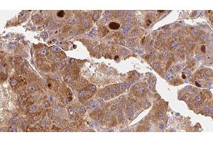 ABIN6276739 at 1/100 staining Human liver cancer tissue by IHC-P. (CD11b 抗体  (Internal Region))