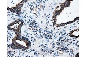 Immunohistochemical staining of paraffin-embedded Adenocarcinoma of colon tissue using anti-SRRmouse monoclonal antibody. (SRR 抗体)