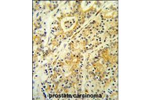 Formalin-fixed and paraffin-embedded human prostate carcinoma reacted with MGST2 Antibody ,which was peroxidase-conjugated to the secondary antibody, followed by DAB staining. (MGST2 抗体  (C-Term))