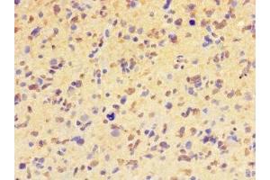 Immunohistochemistry of paraffin-embedded human glioma using ABIN7155399 at dilution of 1:100 (HIST1H2BD 抗体  (AA 2-57))