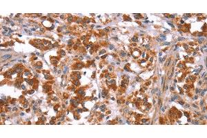 Immunohistochemistry of paraffin-embedded Human thyroid cancer tissue using GLMN Polyclonal Antibody at dilution 1:40 (GLMN 抗体)