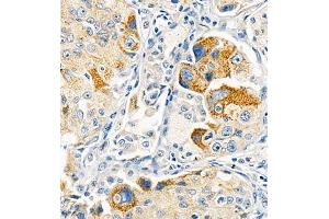 Immunohistochemistry of paraffin embedded human lung cancer using Cdcp1 (ABIN7073600) at dilution of 1:300 (400x lens) (CDCP1 抗体)