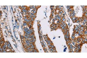 Immunohistochemistry of paraffin-embedded Human gasrtic cancer tissue using ALG2 Polyclonal Antibody at dilution 1:35 (ALG2 抗体)