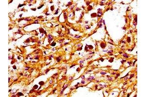 IHC image of ABIN7165944 diluted at 1:100 and staining in paraffin-embedded human melanoma performed on a Leica BondTM system. (PPM1F 抗体  (AA 1-76))