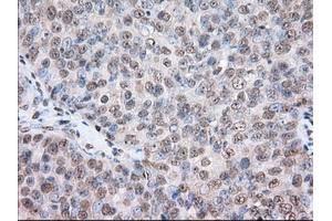 Immunohistochemical staining of paraffin-embedded Human colon tissue using anti-TACC3 mouse monoclonal antibody. (TACC3 抗体)