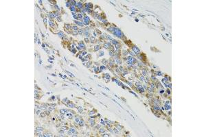 Immunohistochemistry of paraffin-embedded human liver cancer using SH2B1 Antibody (ABIN1876744) at dilution of 1:100 (40x lens). (SH2B1 抗体)