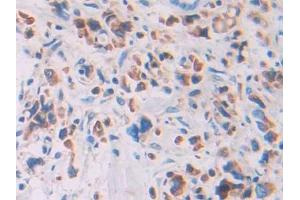 IHC-P analysis of Human Stomach cancer Tissue, with DAB staining. (Ribonuclease A12 (AA 21-147) 抗体)