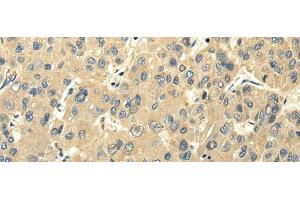 Immunohistochemistry of paraffin-embedded Human liver cancer using PMP2 Polyclonal Antibody at dilution of 1/25 (PMP2 抗体)