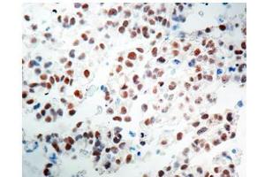Formalin fixed paraffin embedded Testicular Seminoma stained with OCT4 antibody Cat. (OCT4 抗体)