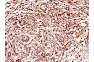 Immunohistochemistry of paraffin-embedded human pancreatic cancer using ABIN7150756 at dilution of 1:100 (DUSP19 抗体  (AA 1-217))