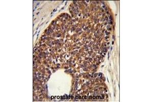 Formalin-fixed and paraffin-embedded human prostate carcinoma reacted with MTBP Antibody (C-term), which was peroxidase-conjugated to the secondary antibody, followed by DAB staining. (MTBP 抗体  (C-Term))