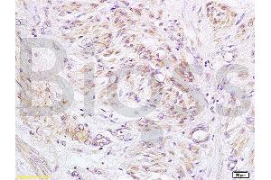 Formalin-fixed and paraffin embedded human cervical carcinoma labeled with Anti-PXMP1/ABCD3/PMP70 Polyclonal Antibody, Unconjugated (ABIN1386868) at 1:200 followed by conjugation to the secondary antibody and DAB staining.