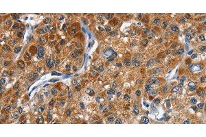 Immunohistochemistry of paraffin-embedded Human liver cancer tissue using DRAK2 Polyclonal Antibody at dilution 1:40 (DRAK2 抗体)