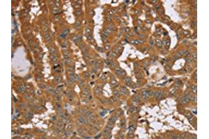 The image on the left is immunohistochemistry of paraffin-embedded Human thyroid cancer tissue using ABIN7192090(RAB14 Antibody) at dilution 1/40, on the right is treated with synthetic peptide. (RAB14 抗体)