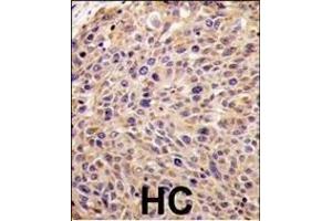 Formalin-fixed and paraffin-embedded human hepatocarcinoma tissue reacted with GGPS1 Antibody (N-term) (ABIN389055 and ABIN2839264) , which was peroxidase-conjugated to the secondary antibody, followed by DAB staining. (GGPS1 抗体  (N-Term))