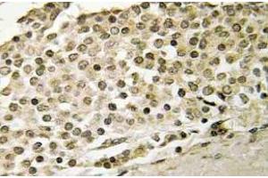 Immunohistochemistry (IHC) analyzes of Cerebral 1 antibody in paraffin-embedded human breast carcinoma tissue. (APP 抗体)