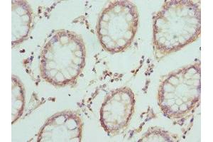 Immunohistochemistry of paraffin-embedded human colon cancer using ABIN7146851 at dilution of 1:100 (CRTAP 抗体  (AA 20-240))