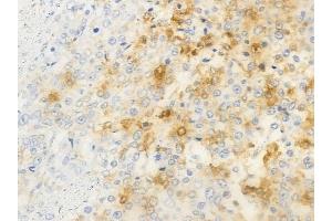 ABIN6263736 and ABIN6266891 at 1/100 staining human prostate carcinoma by IHC-P. (NRIP2 抗体  (N-Term))