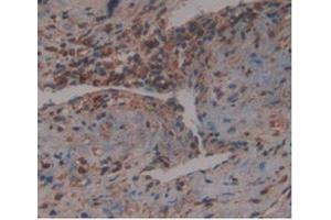 IHC-P analysis of Human Prostate Gland Cancer Tissue, with DAB staining. (GDF3 抗体  (AA 251-364))