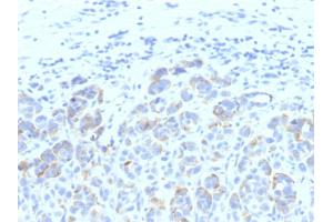 Formalin-fixed, paraffin-embedded human Melanoma stained with TYRP1 MAB (SPM611) (Tyrosinase-Related Protein 1 抗体)