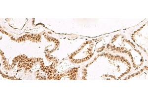 Immunohistochemistry of paraffin-embedded Human thyroid cancer tissue using DGCR6L Polyclonal Antibody at dilution of 1:65(x200) (DGCR6L 抗体)