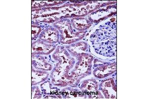 HTRA2 Antibody (N-term) (ABIN657628 and ABIN2846624) immunohistochemistry analysis in formalin fixed and paraffin embedded human kidney carcinoma followed by peroxidase conjugation of the secondary antibody and DAB staining. (HTRA2 抗体  (N-Term))