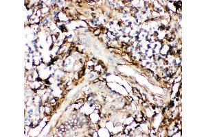 Anti-Annexin V Picoband antibody,  IHC(P): Human Intestinal Cancer Tissue