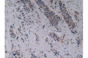 IHC-P analysis of Human Breast Cancer Tissue, with DAB staining. (RANKL 抗体  (AA 79-247))