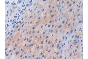 IHC-P analysis of Human Liver cancer Tissue, with DAB staining. (PIK3CB 抗体  (AA 807-1070))