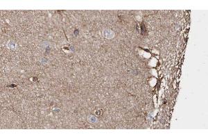 ABIN6279059 at 1/100 staining Human brain cancer tissue by IHC-P. (ABLIM1 抗体  (N-Term))