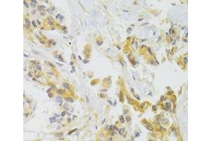 Immunohistochemistry of paraffin-embedded Human breast cancer using EIF4G1 Polyclonal Antibody at dilution of 1:100 (40x lens). (EIF4G1 抗体)