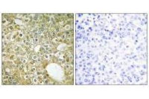 Immunohistochemistry analysis of paraffin-embedded human breast carcinoma tissue using ACVL1 antibody. (ACVRL1 抗体)