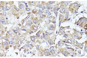 Immunohistochemistry of paraffin-embedded Human liver cancer using EIF3L Polyclonal Antibody at dilution of 1:100 (40x lens). (EIF3L 抗体)