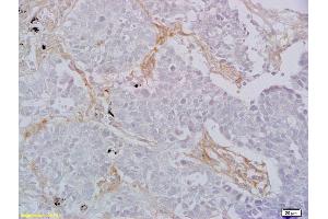 Formalin-fixed and paraffin embedded human lung carcinoma labeled with Rabbit Anti CD8 Polyclonal Antibody, Unconjugated (ABIN1385272) at 1:200 followed by conjugation to the secondary antibody and DAB staining (CD8 抗体  (AA 51-150))