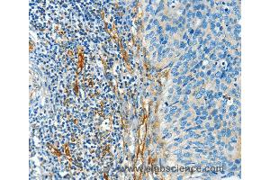 Immunohistochemistry of Human cervical cancer using DIO2 Polyclonal Antibody at dilution of 1:50 (DIO2 抗体)