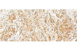 Immunohistochemistry of paraffin-embedded Human prost ate cancer tissue using RPS27A Polyclonal Antibody at dilution of 1:40(x200) (RPS27A 抗体)