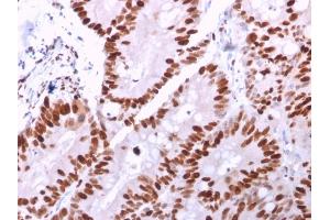 Formalin-fixed, paraffin-embedded human Colon Carcinoma stained with MCM6 Mouse Monoclonal Antibody (MCM6/2999).