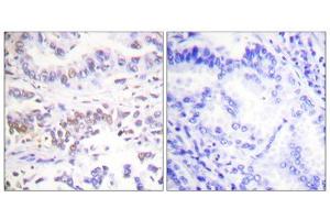 Immunohistochemistry analysis of paraffin-embedded human lung carcinoma tissue using XRCC3 antibody. (XRCC3 抗体  (Internal Region))