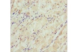 Immunohistochemistry of paraffin-embedded human gastric cancer using ABIN7171148 at dilution of 1:100 (SNAP29 抗体  (AA 1-258))