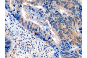 Detection of ICOSLG in Human Colorectal cancer Tissue using Polyclonal Antibody to Inducible T-Cell Co Stimulator Ligand (ICOSLG)