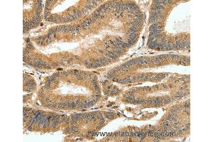Immunohistochemistry of Human ovarian cancer using S100A4 Polyclonal Antibody at dilution of 1:80 (s100a4 抗体)
