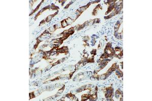 Anti-CYP2U1 antibody, IHC(P) IHC(P): Human Intestinal Cancer Tissue (CYP2U1 抗体  (C-Term))