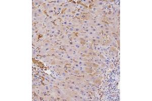 Immunohistochemical analysis of E on paraffin-embedded Human hepato carcinoma tissue. (beta 2 Adrenergic Receptor 抗体  (AA 345-373))