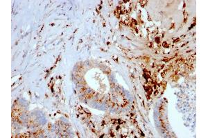 Formalin-fixed, paraffin-embedded human Liver Carcinoma and Macrophages stained with Cathepsin D Mouse Monoclonal Antibody (CTSD/3082). (Cathepsin D 抗体  (AA 104-250))
