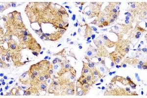 Immunohistochemistry of paraffin-embedded Human gastric cancer using BMPR1B Polyclonal Antibody at dilution of 1:200 (40x lens). (BMPR1B 抗体)