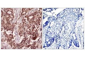 Immunohistochemical analysis of paraffin-embedded human breast carcinoma tissue, using NFκB-p105/p50 (Phospho-Ser927) antibody (E011312). (NFKB1 抗体  (pSer927))
